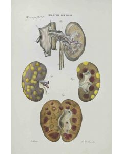 Ottavio Muzzi - Kidney Disease - Contemporary Art 